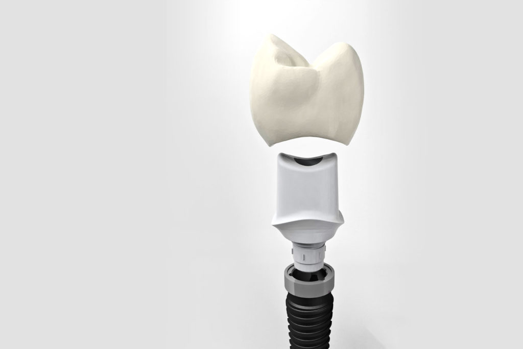 dental implants westerly ri - new london ct