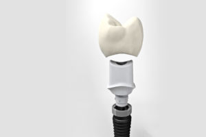 dental implants westerly ri - new london ct