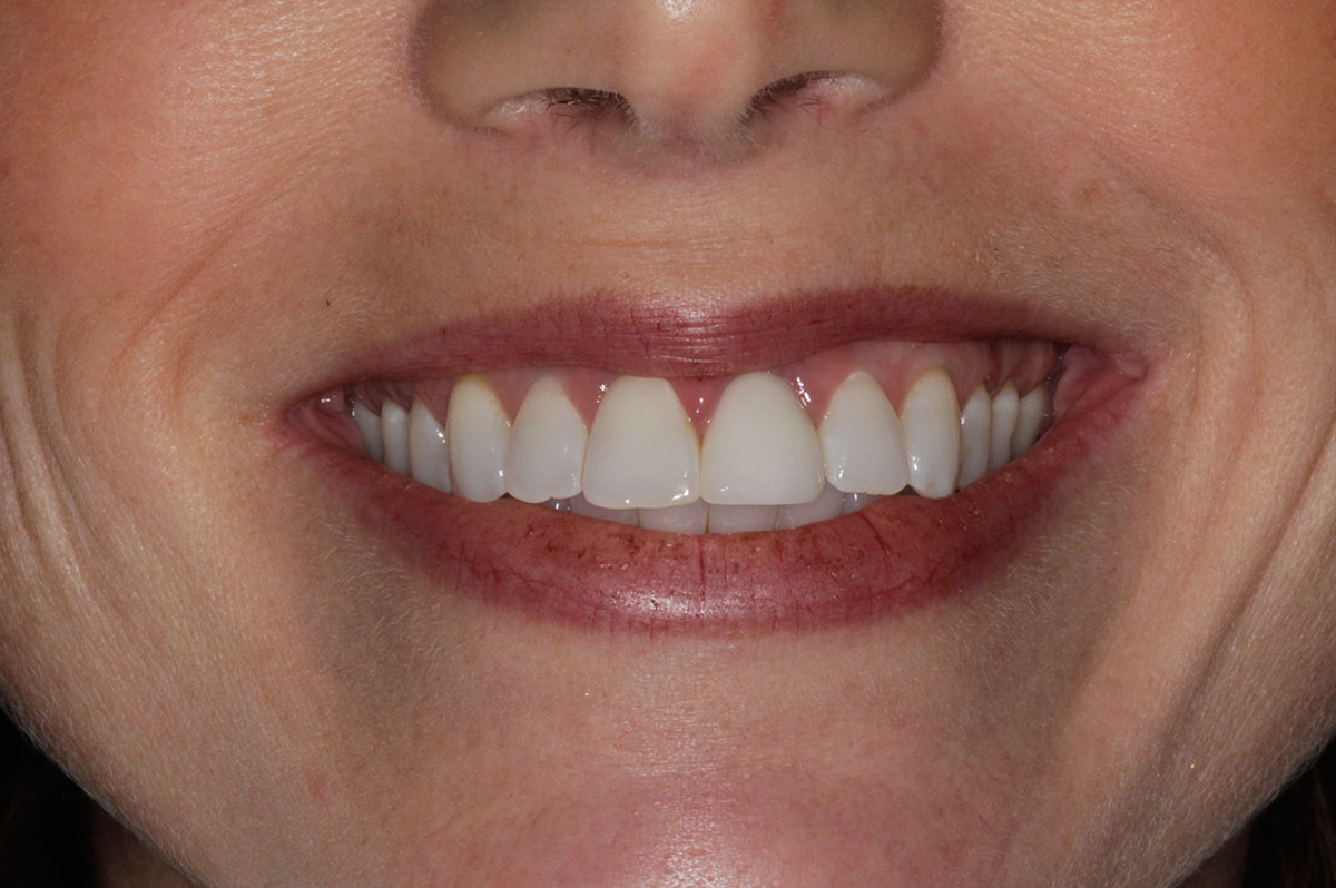 Dental Implants Overview New London, CT Westerly, RI