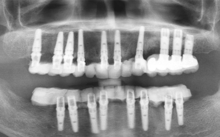 Traditional Implants