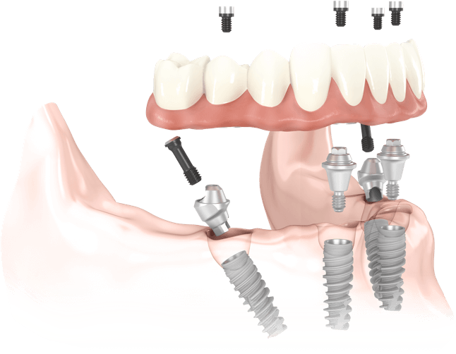 all-on-4-dental-implant-transparent
