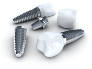 dental implants