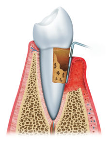 Receding Gum Diagram