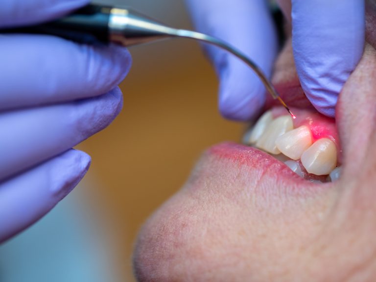 Gingivectomy New London CT Westerly RI Shoreline Perio