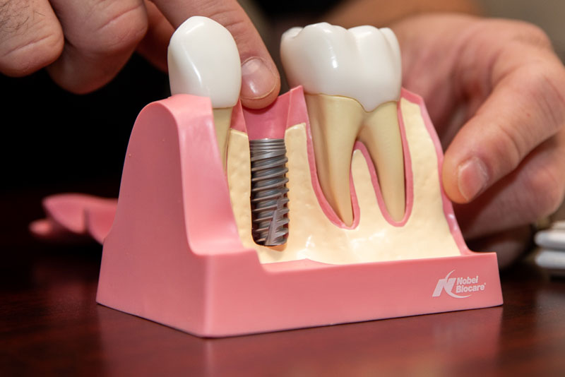 Dental Implant In Your Bone Model