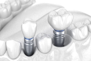 Dental Implant Model