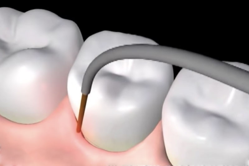 LANAP Laser Gum Disease Treatment