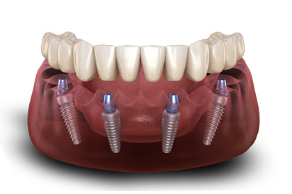 Teeth In A Day Dental Implant Bridge