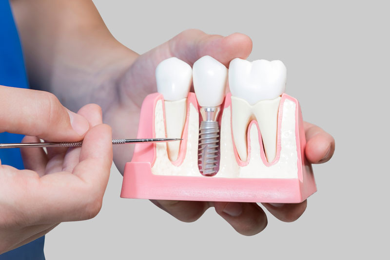 Dental Assistant Showing Off A Dental Implant In A Jawbone Cutaway Model in New London, CT